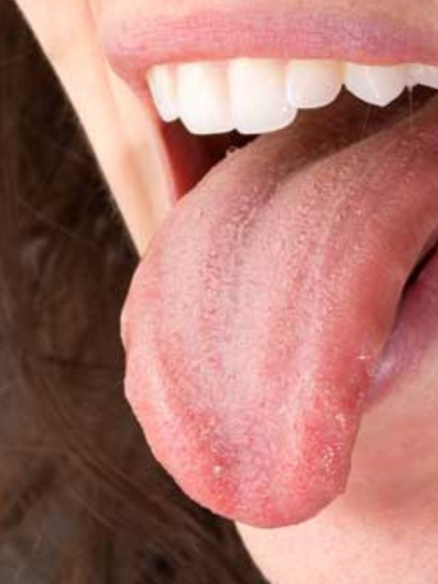 मुंह के छालों से बचने के लिए घरेलू उपचार